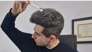 Microneedling for hair loss and regrowth [upl. by Nylarac]