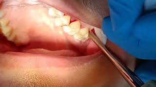 wisdom tooth extraction healing process 7 [upl. by Abey263]