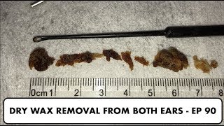 DRY EAR WAX REMOVAL FROM BOTH EARS  EP 90 [upl. by Favin368]