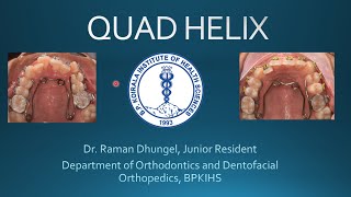 Quad helix appliance in Orthodontics [upl. by Anelet164]