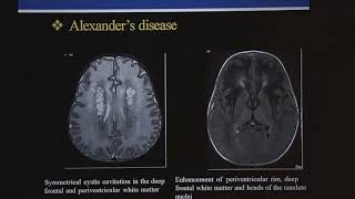 TMT MRI in Pediatric White Matter Diseases  IV by Dr Deepak Patkar [upl. by Hoeve]