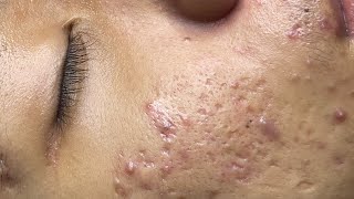 ACNE TREATMENT VU QUYNH MI Acne On Boys Nose 2024 [upl. by Ahsienod]