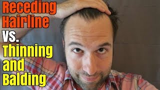 Receding Hairline Vs Thinning and Balding [upl. by Nojid]