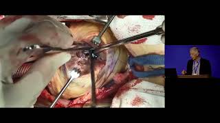 Surgical Management of Nonobstructive Hypertrophic Cardiomyopathy [upl. by Carolle]