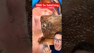 Worlds Best PORE STRIP REMOVAL 2024 shorts [upl. by Dieter]