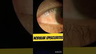 Nodular Episcleritis nodularepiscleritis eyediseases [upl. by Obbard]