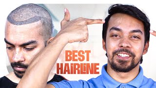 Hairline Revival Receding Hairline Restored 😍  Hair Transplant Bangladesh  New Roots [upl. by Narayan472]