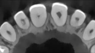 Management of a sclerotic maxillary central incisor associated with a periapical lesion [upl. by Idolah652]