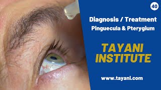 Pinguecula amp Pterygium Diagnosis  Tayani Institute [upl. by Fine]