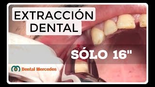 COMO SACAR RAÍZ DENTAL Sin tapujos sólo 16quot resto RADICULAR del 15 ¡¡compruébalo ahora [upl. by Claudianus]