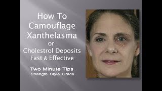 Xanthelasma or Cholesterol Deposits and How to Camouflage Easily amp Effectively for Great Makeup [upl. by Adnyleb339]