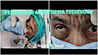 Peribulbar Anesthesia Technique How To Achieve Adequate Akinesia For Ocular Surgery [upl. by Landahl]