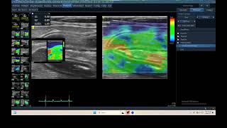 IQ 304 PANCREATIC ULTRASOUND ECHOPAC ANALYSIS ELASTOGRAPHY [upl. by Larner]