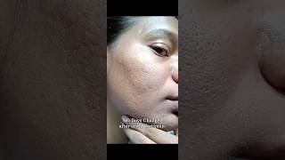 60 Days Change After Using Tretinoin 0025 tretinoin skincare viralvideo shorts youtubeshorts [upl. by Udela]