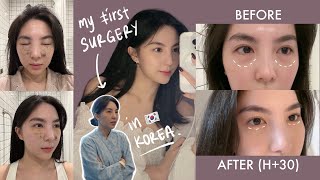 My FIRST SURGERY in Korea 🇰🇷  PRICE  Undereye Fat Removal  VLOG [upl. by Yauq]