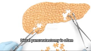 My Distal Pancreatectomy Experience What to Expect [upl. by Aerol]