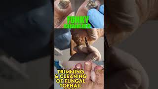 Part 3 Best of Callus Treatments Podiatry  Fungal Nail with Dried Abscess 🦶 Ingrown Nail Treatment [upl. by Fidole]