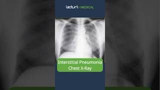 Understanding Interstitial Pneumonia 🫁 MedicalEducation usmle [upl. by Nyrmak]