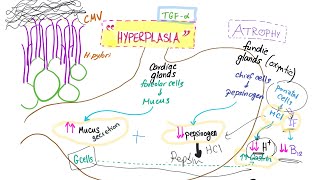 Ménètriers disease mechanism diagnosis and ttt [upl. by Ackler]