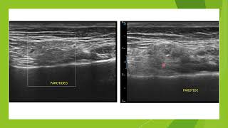 Parotidite en échographie [upl. by Imerej]