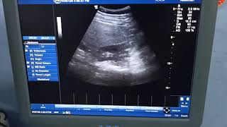 GE Logic C5  Scanning with Convex and TVS probes [upl. by Orlosky995]