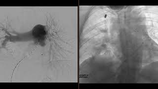 Case Discussion IR Catheter Directed Thrombolysis For High PE Burden [upl. by Sallie]