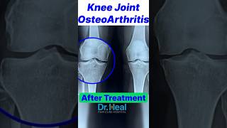 Knee joint Osteoarthritis Recovery After Treatment yt ytshort trending trendingshorts fyp ad [upl. by Nitsid145]