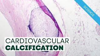 Vitamin K2 and Cardiovascular Calcification [upl. by Mellman]