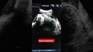 Anencephaly with brain dangling behind in the amniotic fluid anomalyscan [upl. by Drona924]