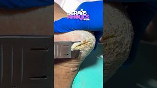 SUPER DRY FLAKY HEEL SCRAPE 🧀🤤 scrapeaholics heelscrape podiatry [upl. by Neruat]