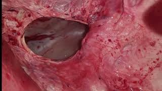 Diaphragmatic hernia l Tympani l Bloat l Dr Umar khan [upl. by Areht]