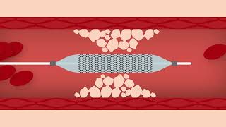 Heart Stent Procedure [upl. by Chrisy]