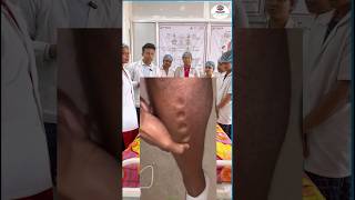 Edema  Health Sector edema nursing medical shorts youtubeshorts healthsector viralshorts [upl. by Noble]