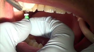 root canal treatment part 1 [upl. by Niamart337]