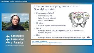 Complications in Spondyloarthritis [upl. by Fanchet]