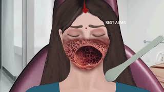 ASMR Animation treatment from infected mouth  2D Animation restasmr1 [upl. by Dafodil]