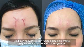 Testimonio de cicatriz hipertrófica  Clínica Dermatológica Ollague [upl. by Bibbye]