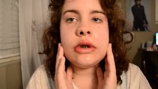 Day two after Double Jaw Surgery  Genioplasty [upl. by Grannias]