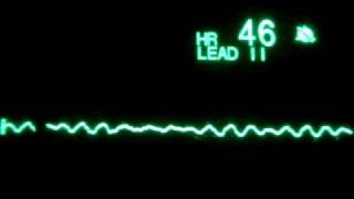 Fine Ventricular Fibrillation [upl. by Ihp]