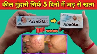 acnestar gel review एक्ने पिंपल्स जड़ से खत्म करने की दवा acnestar gel kaise use kare  acnestar [upl. by Diehl]