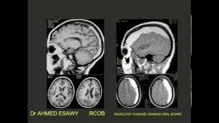 1Radiology Channel Imaging oral board of CNS I imaging [upl. by Alper]