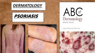 DERMATOLOGY PSORIASIS autoimmunedisease derma psoriasis [upl. by Nanreh]