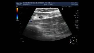 Enlarged Mesenteric Lymph nodes in a child of 6 years [upl. by Seow]