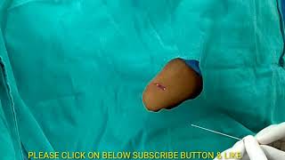 Lumbar Puncture Procedure in Hindi spinal tap diagnostic Procedure [upl. by Stokes]