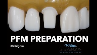 PFM Preparation for 8 Kilgore  Stevenson Dental Solutions [upl. by Dorene756]