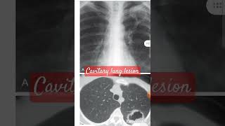 CT  X ray of cavitary lung lesion [upl. by Spratt]