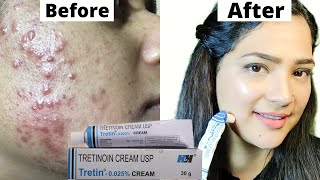 Acne Treatment At Home  TretinoinRetino A 0025cream [upl. by Odericus]