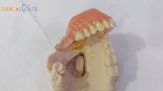 Definitive obturator maxillofacial prosthesis [upl. by Kitarp]