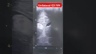 Cranial ultrasound in preterm neonate shows intraventricular hemorrhage G3 neonates hemorrhagic [upl. by Lehpar]