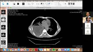 Liver and lung cysts with water lily sign  diagnosis Dr Omar Kallas [upl. by Meldon]